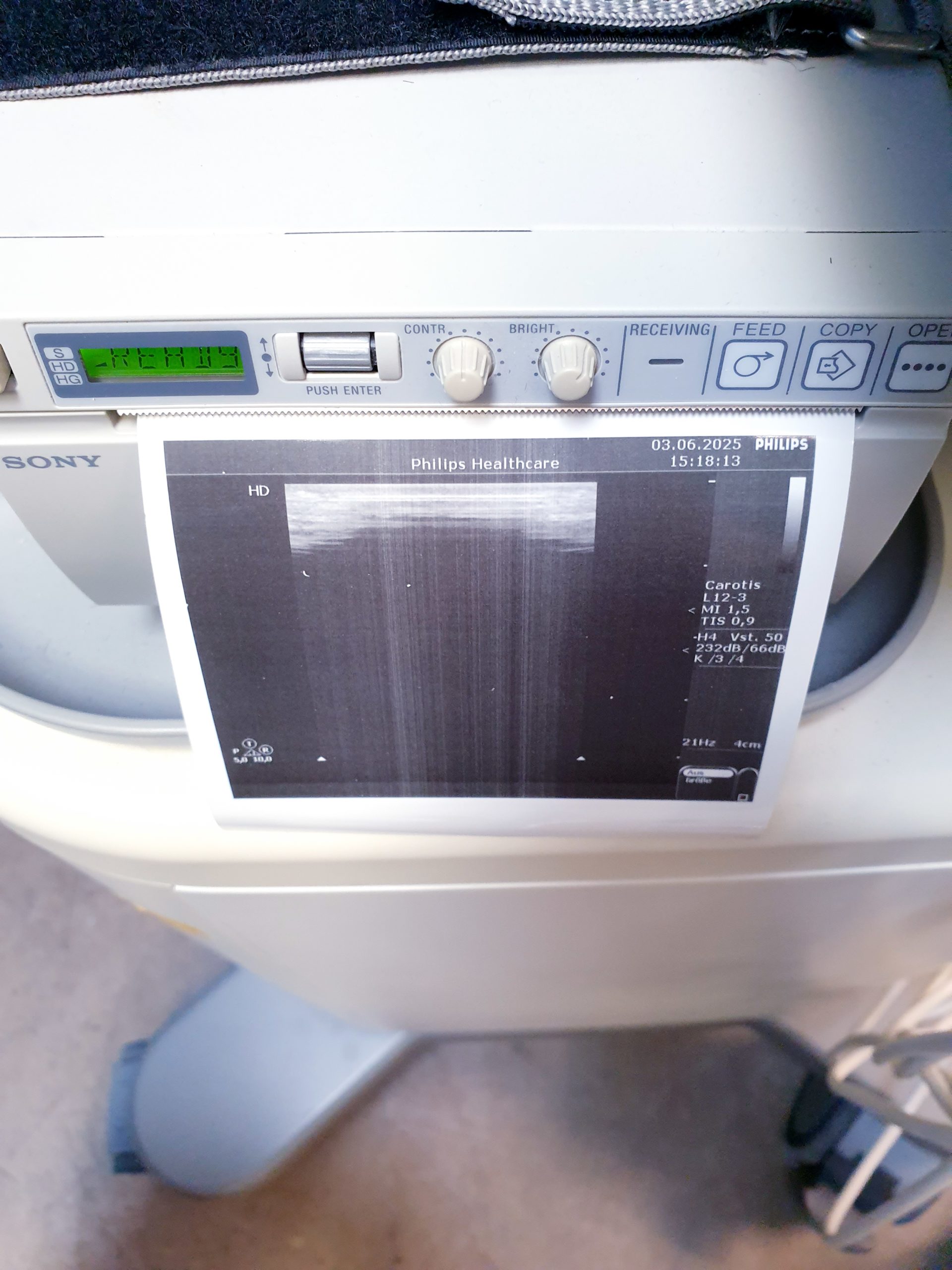 Philips HD 5 HD5 + C5-2 + C8-4v + L12-3 – Gynmaschine Farbdoppler – Bild 14