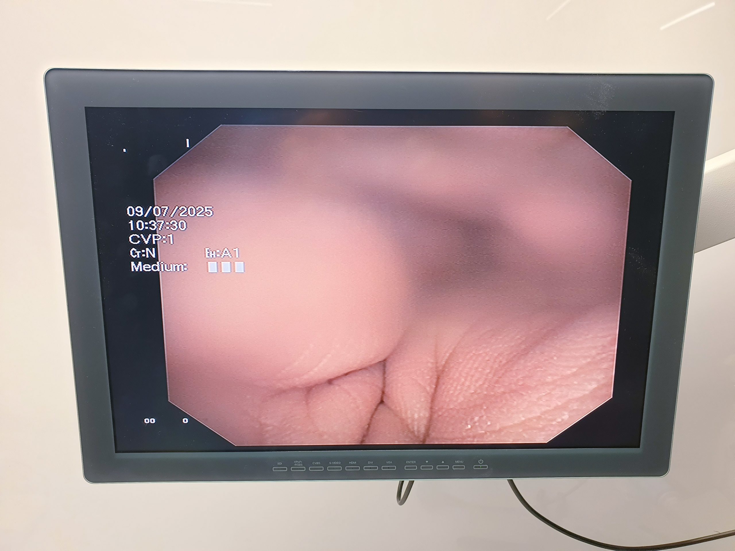 Olympus EVIS EXERA II BF-1TQ180 BF 1 TQ 180 Video Bronchoskop – Bild 12