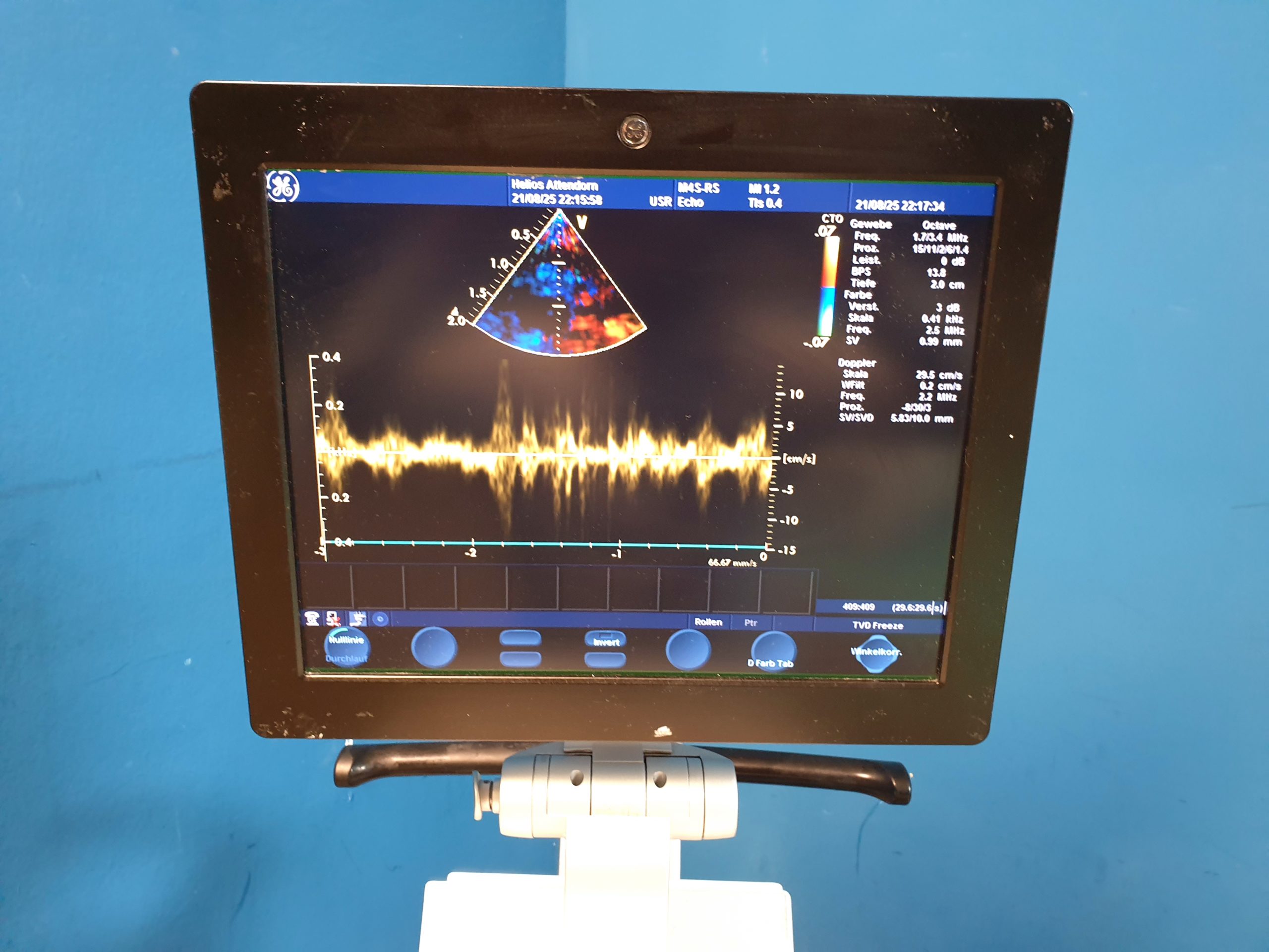 GE Vivid + M4S- RS Kardio Sonde -defekt - Optischer Fehler – Bild 5
